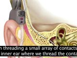 Hearing Aids, Cochlear Implants and Assistive Listening Devices - CAPTIONED