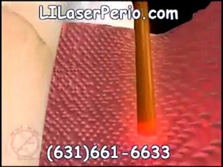 Long Island Periodontist uses a laser