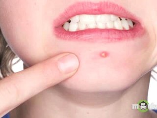 Products that Treat Acne