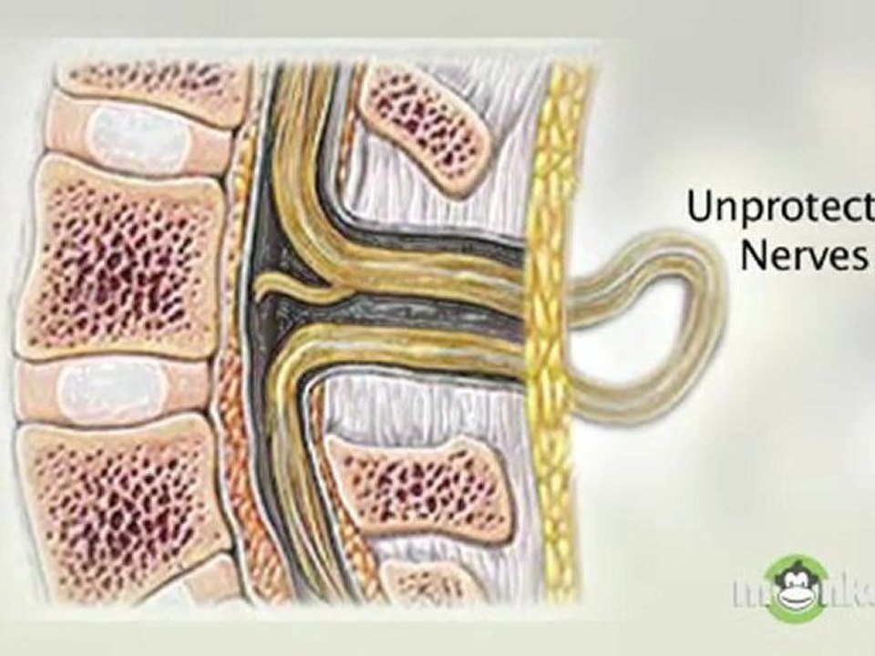 Diagnosing Spina Bifida