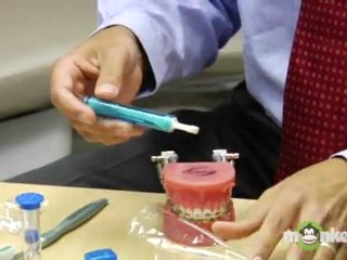 Cleaning Braces-Proper Brushing Technique
