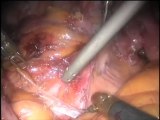 Robotic Surgery: Total Mesorectal Excision in severely obese female patients