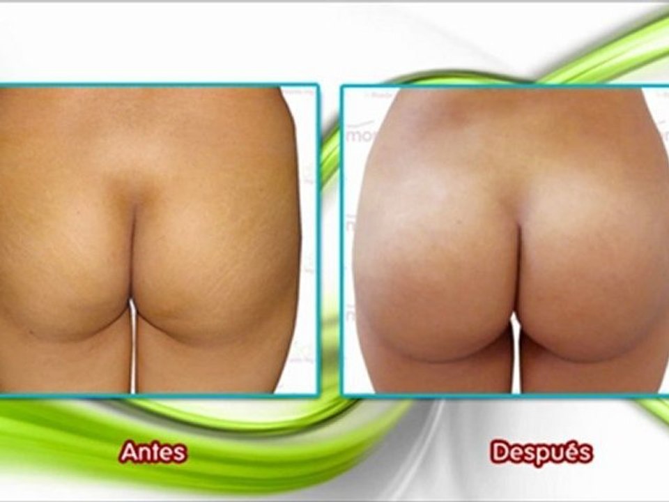 implante de gluteos precios