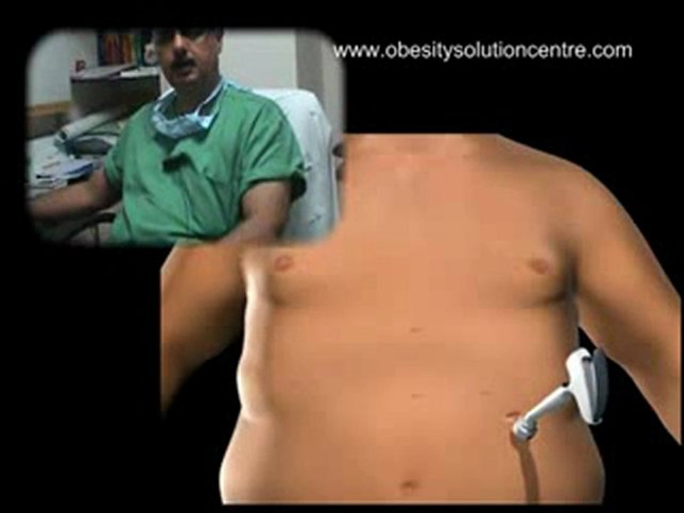 laparoscopic bariatric surgery | laparoscopic weight loss surgery | laparoscopic bariatric
