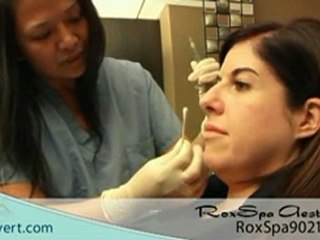 Discover Expert Dermal Filler Treatments at RoxSpa Beverly Hills ✨