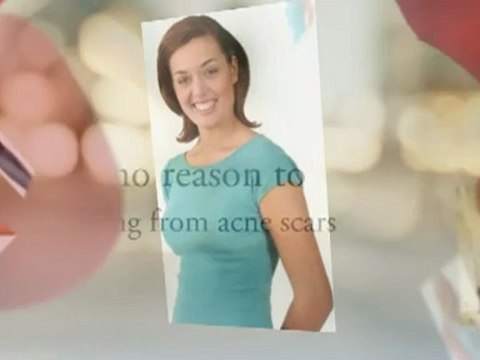 Fade Acne Scars Treatments - Good News