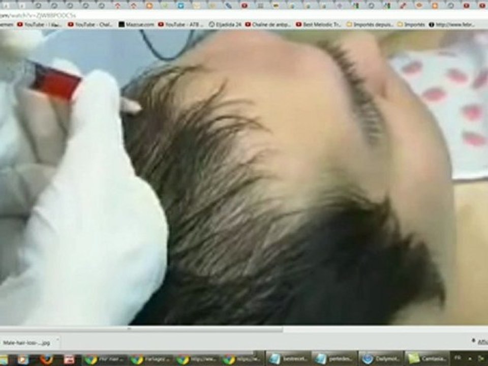 traitement chute de cheveux