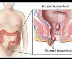 Treatment for Hemorrhoids @ hemorrhoids piles, curing hemorrhoids, hemorrhoids relief