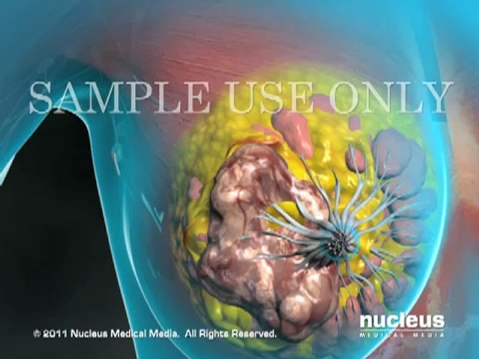 Breast Surgery Animation