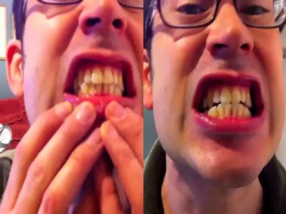 Teeth Whitening Technology