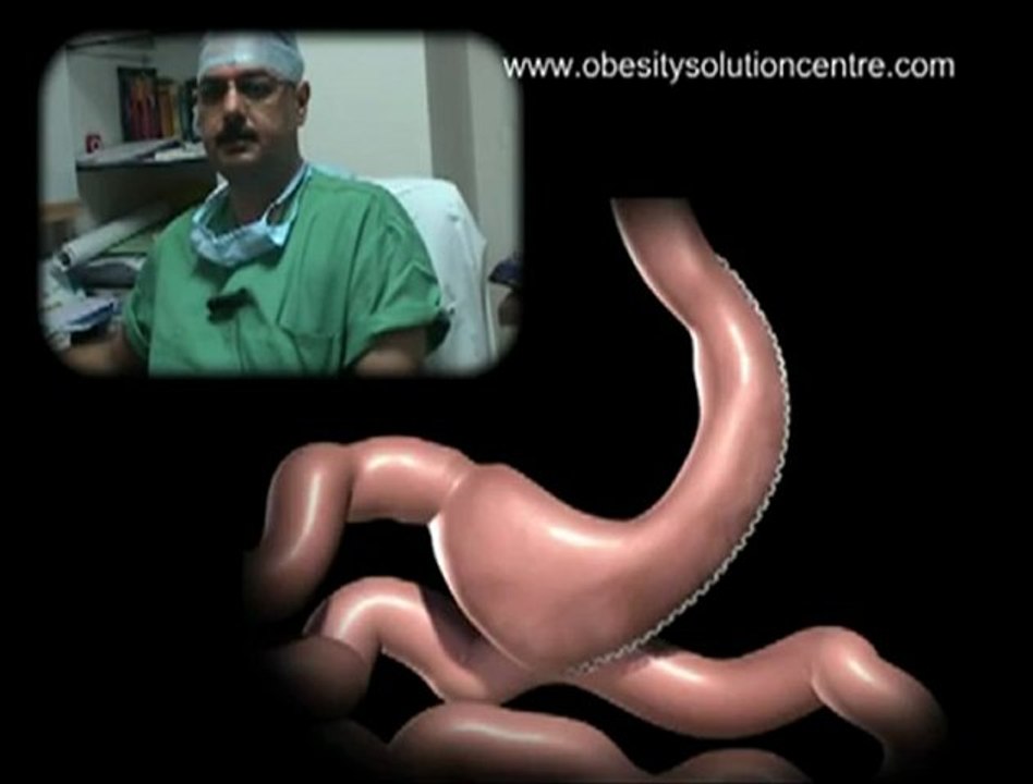 Obesity Solution Centre | Vertical Gastric Sleeve | Sleeve Gastrectomy