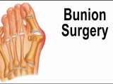 Bunion Surgery - Podiatrist in Lake Success and Valley Stream, NY