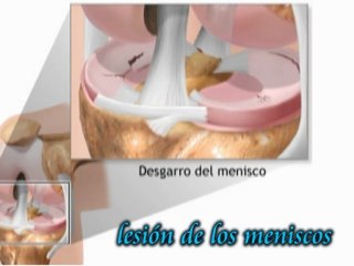 LESIÓN DE RODILLA. CÁMARA HIPERBÁRICA PERÚ