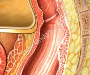 Digestive System Animation: Hemorrhoids