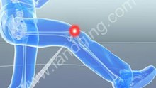 Accident Animation | Sports Injury - Soccer