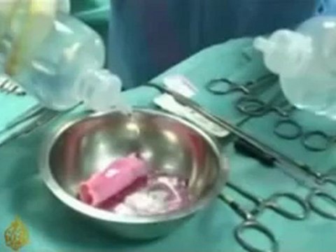 Stem cells used in organ surgery - 20 November 2008