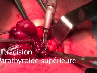www.orl-toulouse.pro Ultracision chirurgie Thyroide