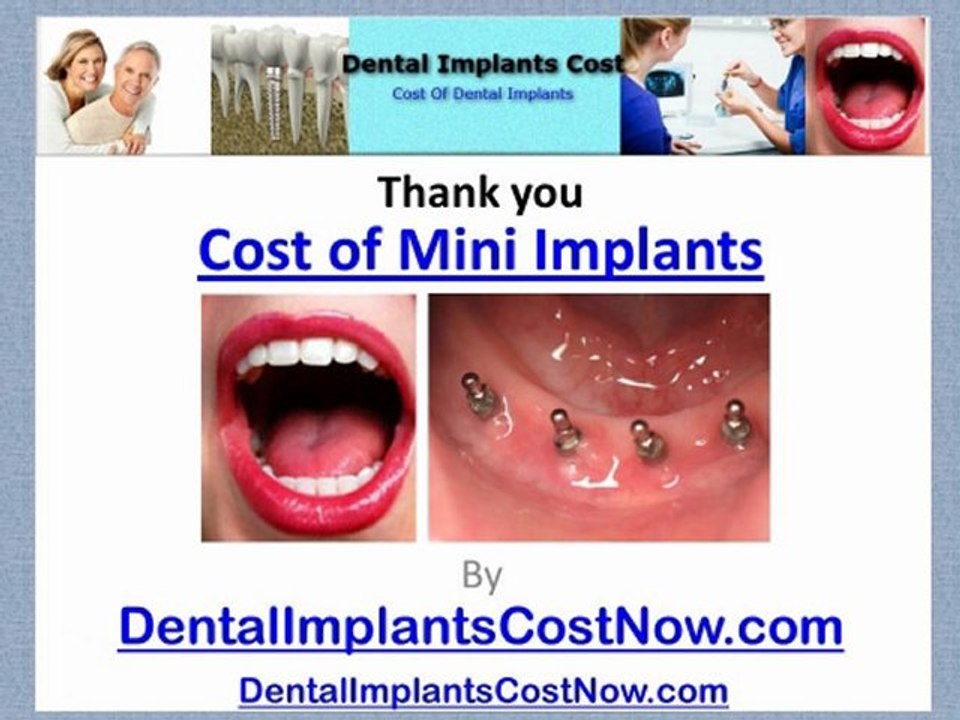 Cost Of Mini Implants