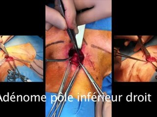chirurgie parathyroide www.orl-toulouse.pro
