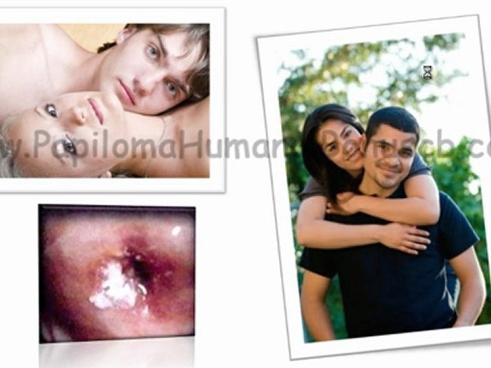 TRATAMIENTO PARA EL VPH EN HOMBRES