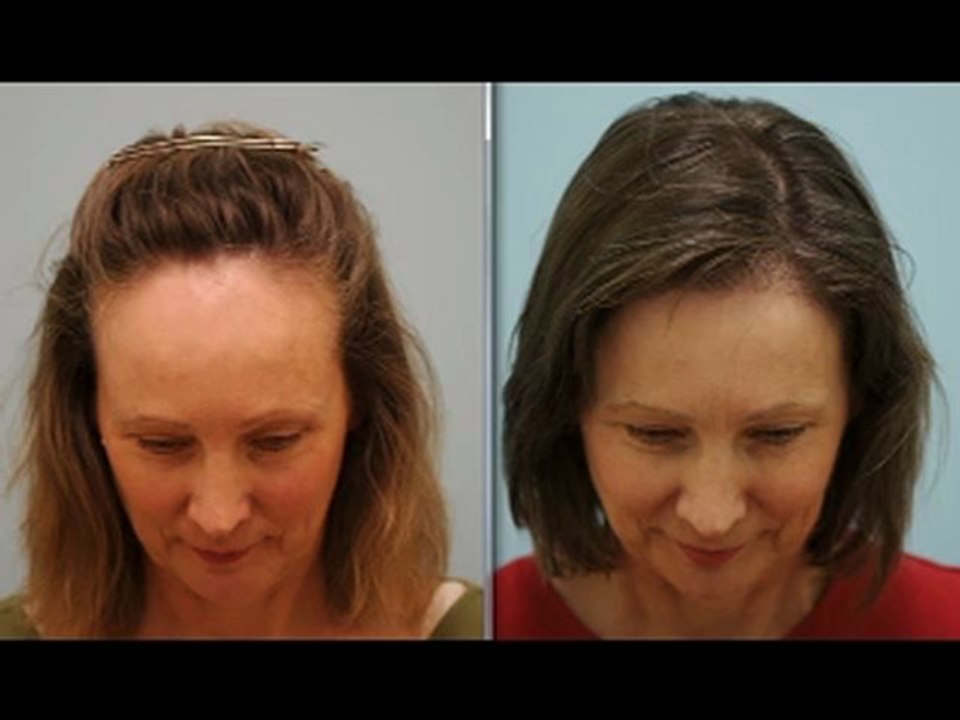 FEMALE HAIRLINE LOWERING WITH HAIR TRANSPLANT TESTIMONIAL