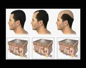 Come bloccare la caduta dei capelli. Video Corso Gratuito