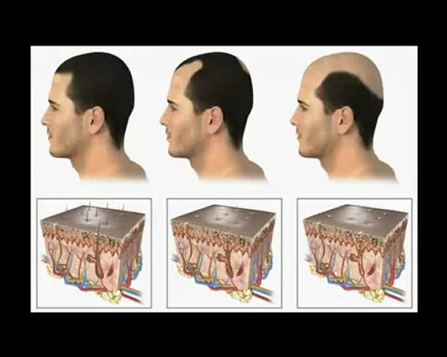 Come bloccare la caduta dei capelli. Video Corso Gratuito