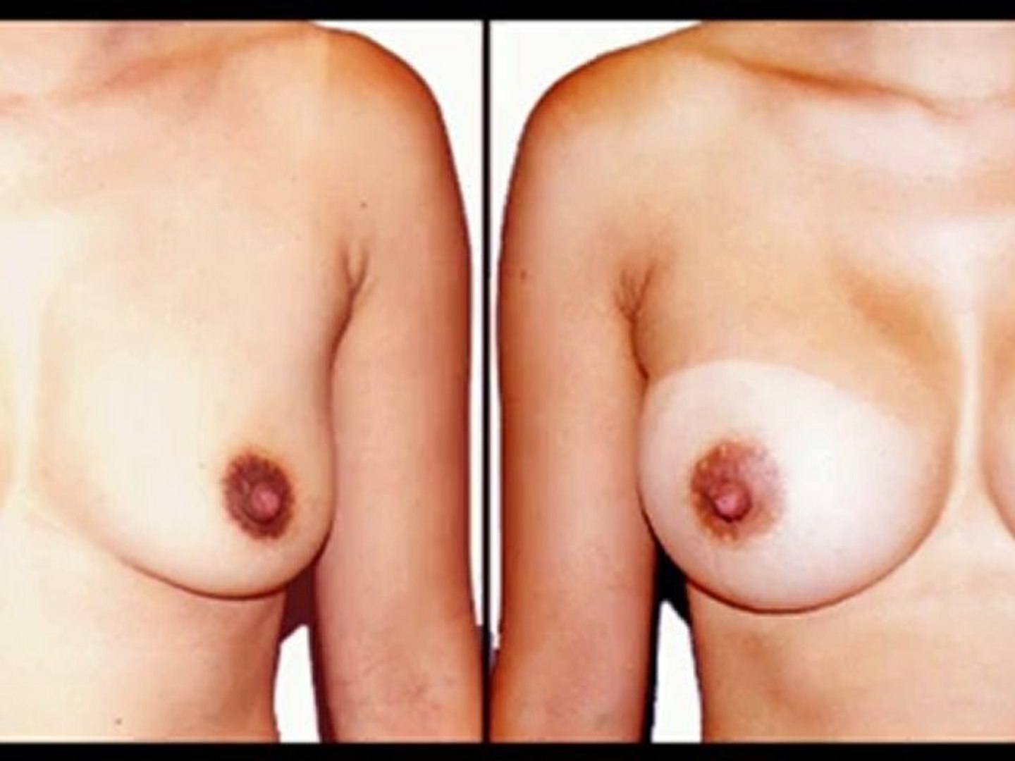 Before and After Plastic Surgery Pictures