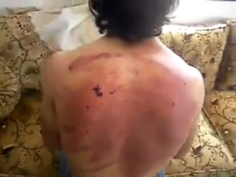 فري برس ريف دمشق آثار ضرب أحد المواطنين على أحد الحواجز في مضايا20 4 2012 Damascus