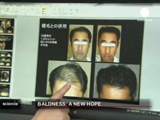 Kelliğe kökten çözüm