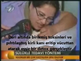 TIBBİ SÜLÜK TEDAVİSİ ANKARA