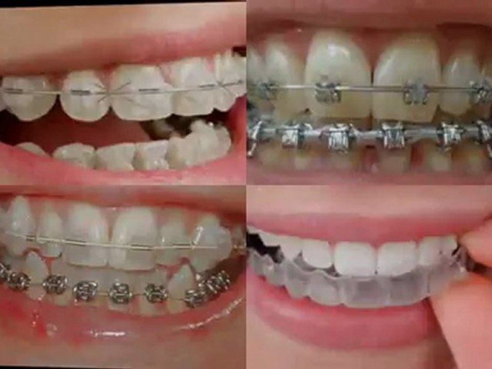 Great Lakes IL Orthodontic Treatment with Braces for Children on Public Aid, Medicaid and All Kids near Great Lakes Illinois.