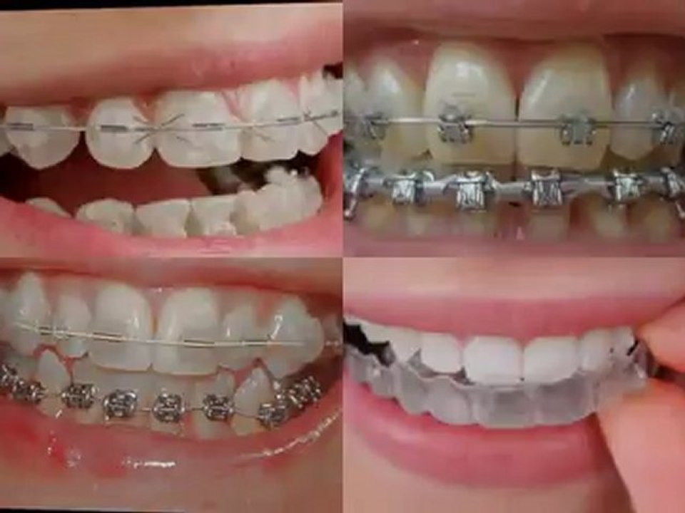Libertyville IL Orthodontic Treatment with Braces for Children on Public Aid, Medicaid and All Kids near Libertyville Illinois.