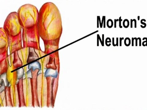 Morton’s Neuroma - Podiatrist in Valley Stream and Lake Success, NY