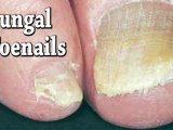 Fungal Toenails - Podiatrist in Valley Stream and Lake Success, NY