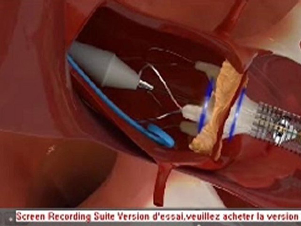 pose-stent-valvé