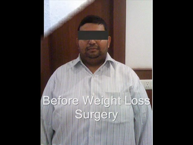 weight loss surgery | weight loss