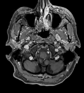 Ciné _Argus ORL par le service de Radiologie Lyon Nord
