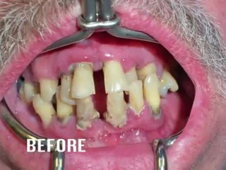Dr. Atcha and teeth ~ NO DENTURES! Dental Implant Center Gets featured on Chicago WGN-9 CW and CLTV