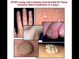 How to get rid of warts naturally home remedies