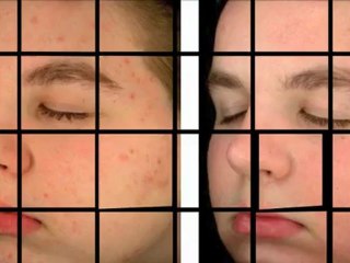 Acne Scar Removal