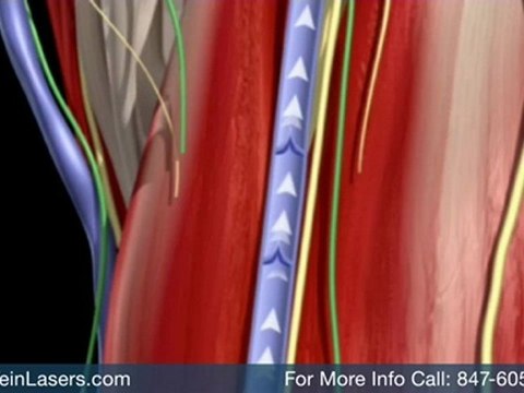 Varicose Vein Treatment Schaumburg, Spider Vein ...