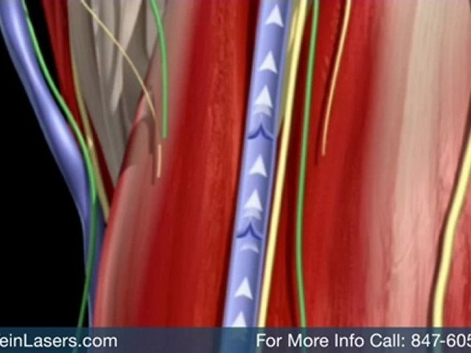 Varicose Vein Treatment Schaumburg, Spider Vein ...