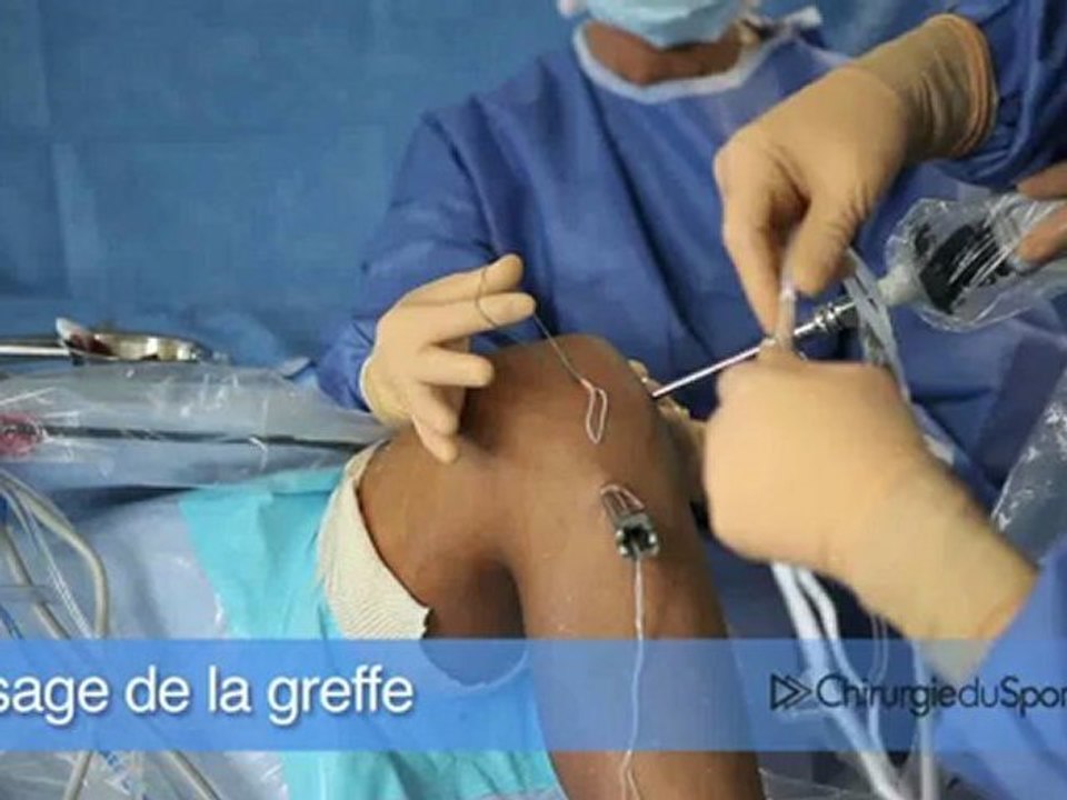 DT4 TLS ou ligamentoplastie du genou pour ruputre du LCA
