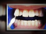 Teeth Whitening Pembroke Pines Mar2012
