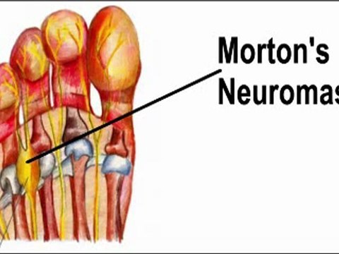 Neuromas - Podiatrist in Frederick, Germantown and Hagerstown, MD