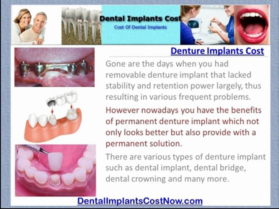 [Denture Implants Cost]