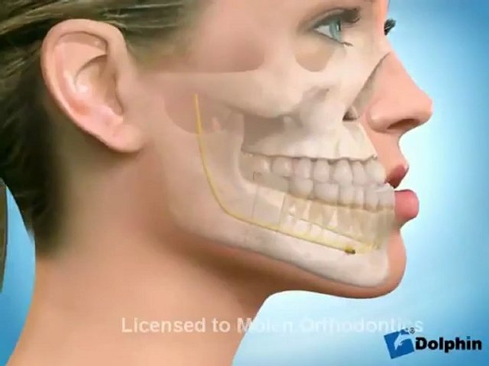 Chirurgie pour Progénie ou Prognathie mandibulaire
