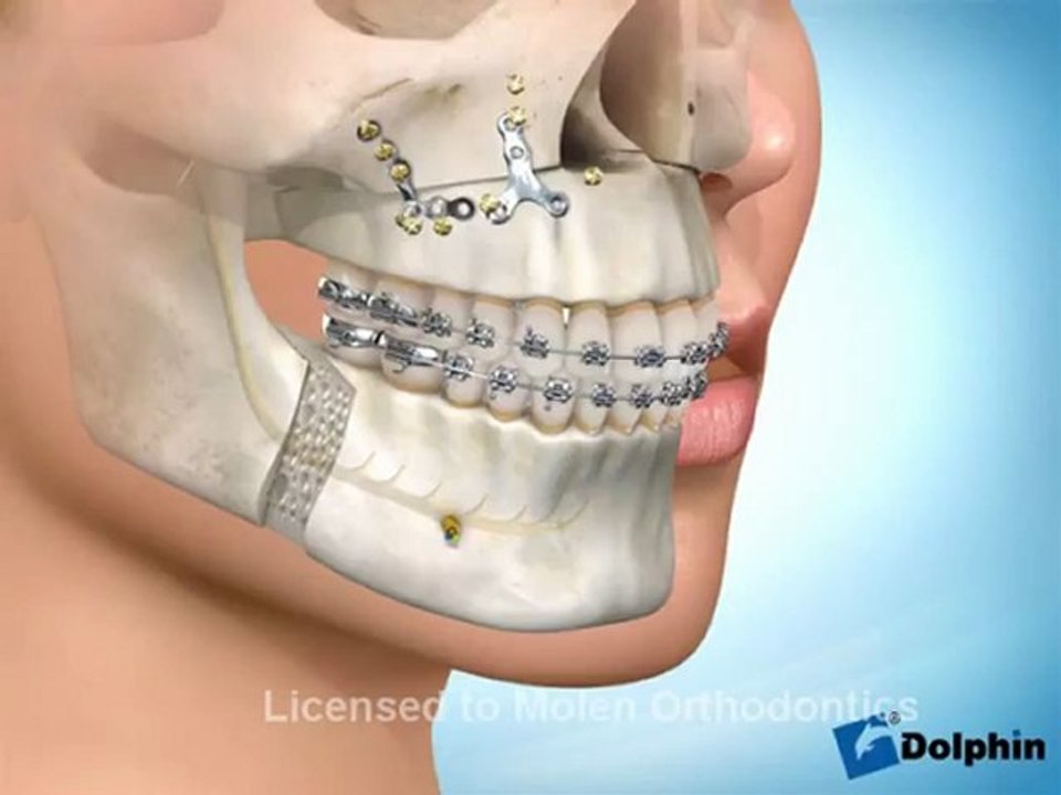 chirurgie maxillaire et orthodontie