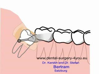extraction de dent de sagesse